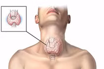 Đi khám viêm họng bất ngờ phát hiện ung thư tuyến giáp