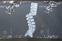 Ngã chấn thương cột sống khi trèo cây hái vải: Bác sĩ cảnh báo gì?