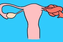 Xoắn buồng trứng nguy hiểm như thế nào?