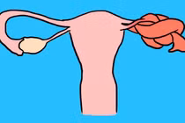 Xoắn buồng trứng nguy hiểm như thế nào?