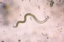 Mắc bệnh hiếm do không tẩy giun nhiều năm: Bác sĩ cảnh báo gì?