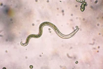 Mắc bệnh hiếm do không tẩy giun nhiều năm: Bác sĩ cảnh báo gì?