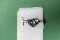 Ngồi xem bạn câu cá, bé trai 13 tuổi bị lưỡi câu móc vào mắt