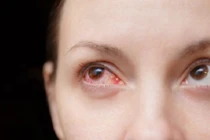 Nhóm thực phẩm người bị bệnh đau mắt đỏ nên tránh xa