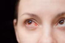 Nhóm thực phẩm người bị bệnh đau mắt đỏ nên tránh xa