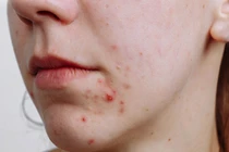 Chăm sóc da mụn cần tránh những thành phần nào?