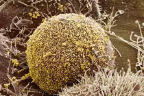 Người thứ 6 khỏi HIV thần kỳ nhờ cấy ghép tủy xương