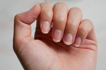 8 dấu hiệu bất thường trên móng tay cảnh báo tình trạng sức khỏe