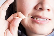 Quảng Ninh: Gắp chiếc tăm dài gần 7cm găm sâu vào dạ dày bệnh nhân