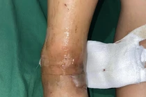 Bị rắn độc cắn, bé trai bị rối loạn đông máu, bàn chân tổn thương nặng