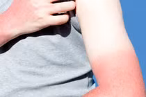 Học ngay 5 mẹo dưỡng da tay cháy nắng đơn giản tại nhà