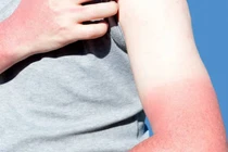 Học ngay 5 mẹo dưỡng da tay cháy nắng đơn giản tại nhà