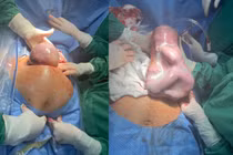 Bình Phước: Bé gái chào đời trong "bọc điều" hiếm gặp