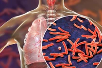  Ho ra 300 ml máu do di chứng lao phổi: Ai có nguy cơ mắc bệnh?