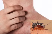 Ký sinh trùng sốt rét gia tăng: Ai có nguy cơ bị bệnh sốt rét?