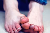 Mẹo phòng ngừa bệnh cước chân tay vào mùa đông