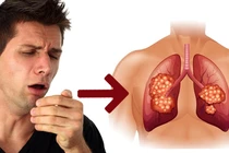 Ho kéo dài: Nguyên nhân và các lưu ý đừng chủ quan