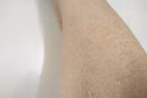 Cách khắc phục tình trạng 'da rắn' - bệnh thường gặp mùa lạnh