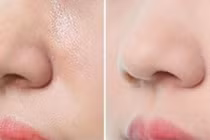 Cách trị sợi bã nhờn trên mũi hiệu quả tại nhà