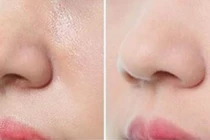 Cách trị sợi bã nhờn trên mũi hiệu quả tại nhà