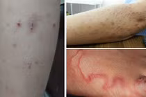 Lở loét khắp người 10 năm mới biết nhiễm giun đũa chó mèo