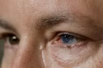 Cấy ghép tế bào gốc tự thân chữa mù lòa