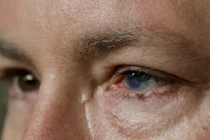 Cấy ghép tế bào gốc tự thân chữa mù lòa