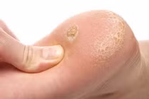 Loại bỏ các vết chai chân cứng đầu với mẹo cực đơn giản