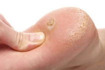 Loại bỏ các vết chai chân cứng đầu với mẹo cực đơn giản