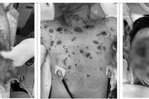 Laptop bất ngờ phát nổ khi đang sạc, bé trai 13 tuổi bị đa chấn thương