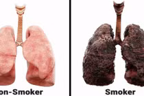 Nhiều bệnh nhân phải cấp cứu vì bệnh lý đường hô hấp do hút thuốc lá
