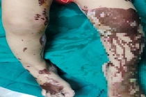 Trẻ bị bỏng axit từ nước tẩy rửa bồn cầu