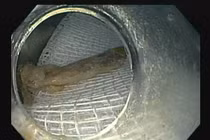 Gắp xương gà 2,5 cm cắm sâu vào thực quản: Cách xử đúng khi hóc xương