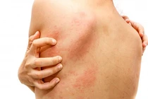 Thuê quần áo chụp ảnh sống ảo, cô gái bị phát ban khắp cơ thể