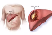 9 dấu hiệu ung thư gan giai đoạn đầu cần lưu ý