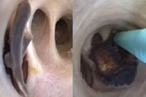 Nhiễm ký sinh trùng vì sở thích ăn cá sống và các món gỏi