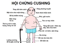 Nhiều người mắc hội chứng Cushing do lạm dụng thuốc corticoid