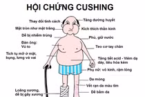 Nhiều người mắc hội chứng Cushing do lạm dụng thuốc corticoid