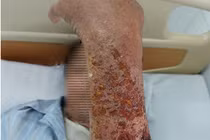 Bị mèo cào, cụ ông mắc căn bệnh nhiễm trùng dễ nguy hiểm tính mạng