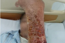 Bị mèo cào, cụ ông mắc căn bệnh nhiễm trùng dễ nguy hiểm tính mạng