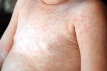 Cách nào phân biệt bệnh sởi và rubella?