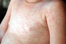 Cách nào phân biệt bệnh sởi và rubella?