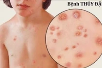 Người mắc bệnh thuỷ đậu nên ăn 3 loại thực phẩm này