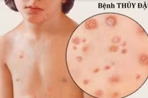 Người mắc bệnh thuỷ đậu nên ăn 3 loại thực phẩm này