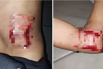 Thanh niên 29 tuổi bị sét đánh ngất ngay trong phòng ngủ