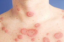 Địa chỉ vàng: Bệnh viện có khả năng chẩn đoán bệnh Lupus ban đỏ