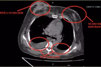 Hiệu quả từ điều trị trúng đích cho người bệnh ung thư vú di căn