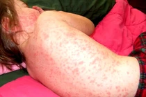 Dấu hiệu bé yêu bị sởi, cha mẹ đặc biệt chú ý