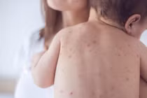 Hà Nội: Tăng cường giám sát bệnh Sởi, xử lý ổ dịch triệt để