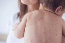 Hà Nội: Tăng cường giám sát bệnh Sởi, xử lý ổ dịch triệt để